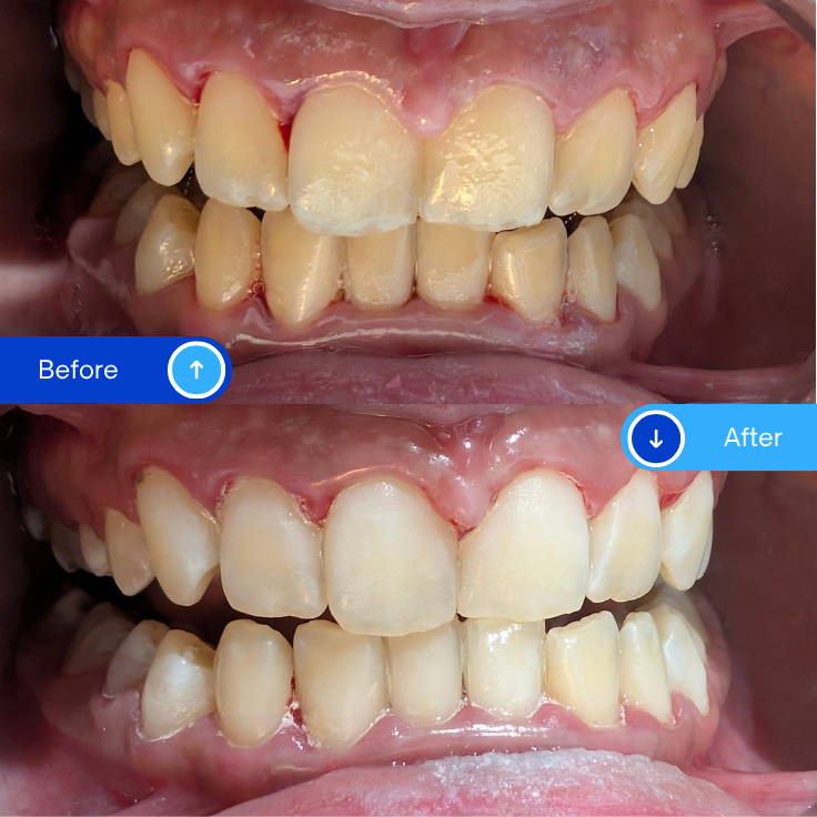 Braces