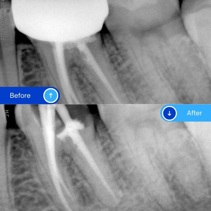 Failed Root Canal Treatment
