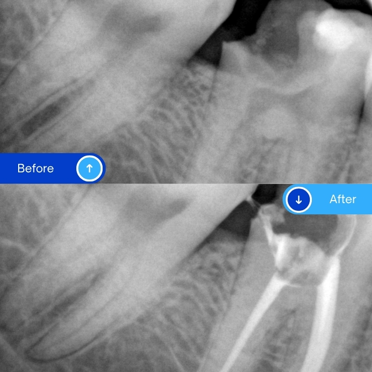 Root canal treatment (13)