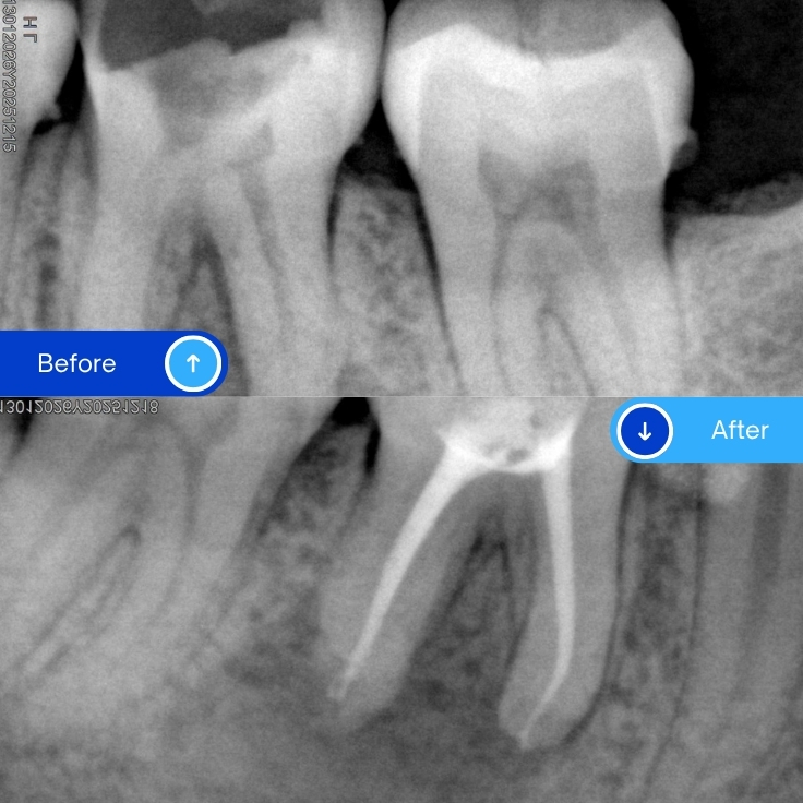 Root canal treatment (14)