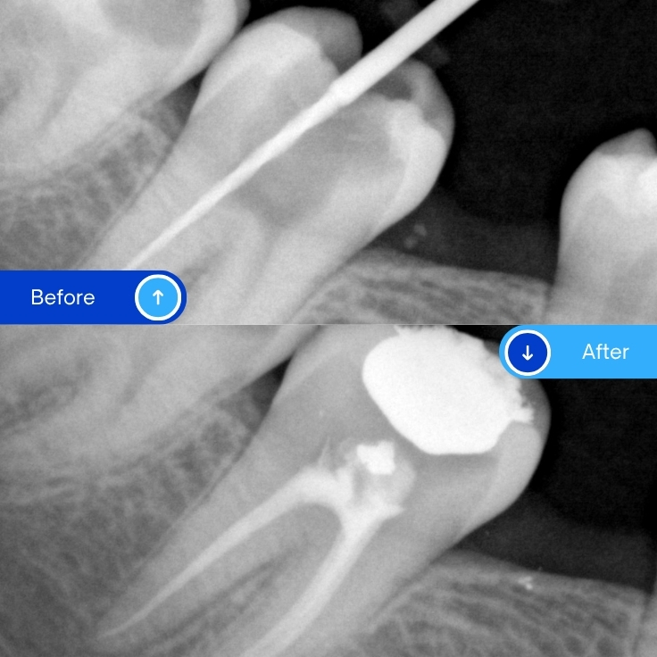 Root canal treatment (5)