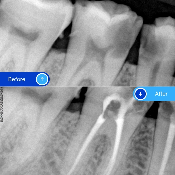 Root canal treatment (6)