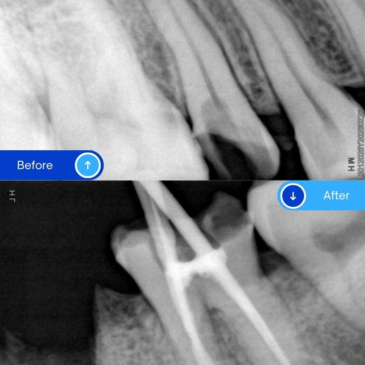 Root canal treatment (7)