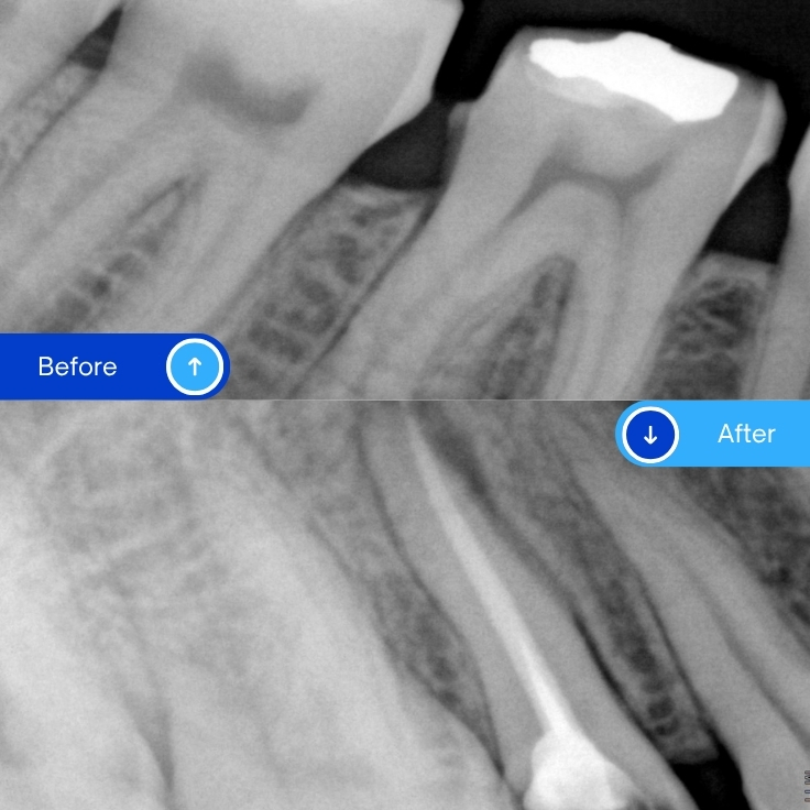 Root canal treatment (8)