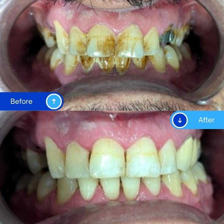 Scaling & Polishing (1)