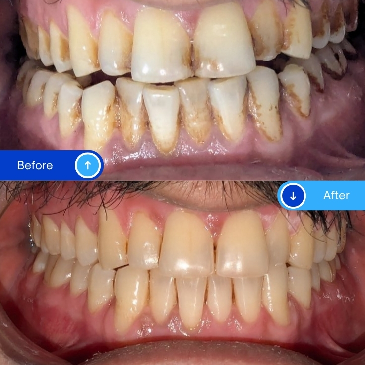 Scaling & Polishing (2)
