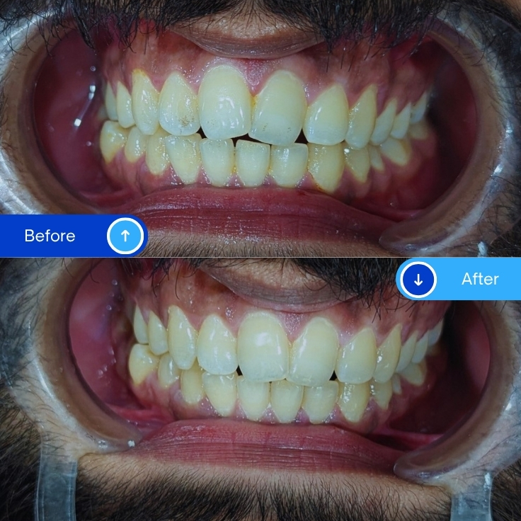 Scaling & Polishing
