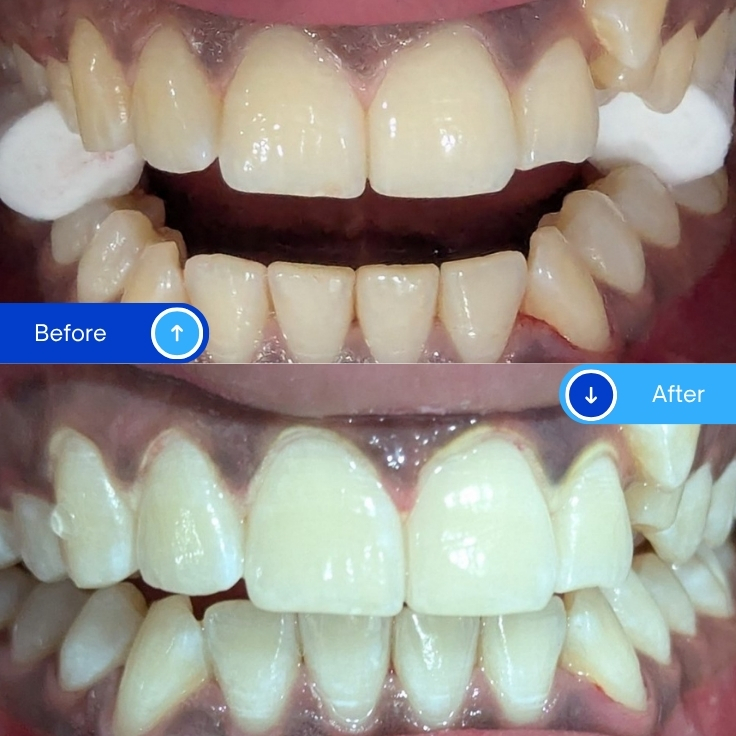 Teeth Whitening