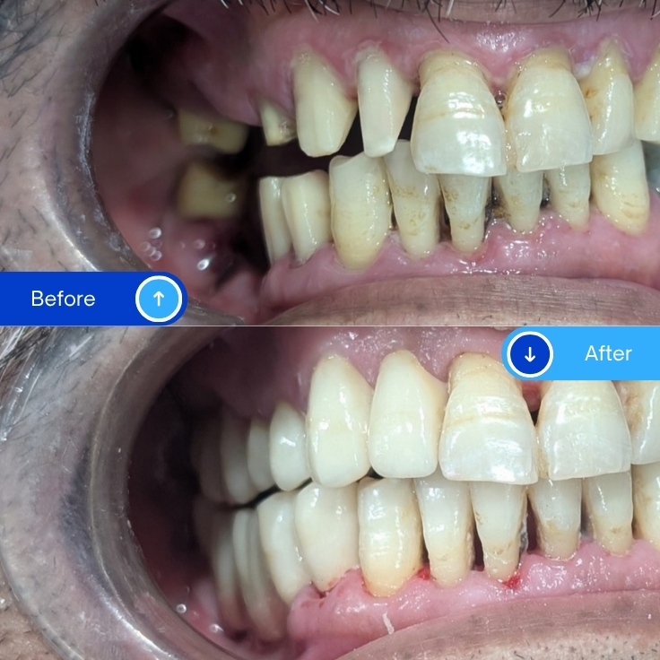Zirconia Bridge