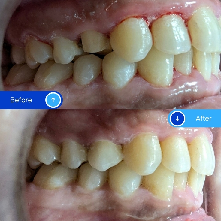 Zirconia Crowns (2)