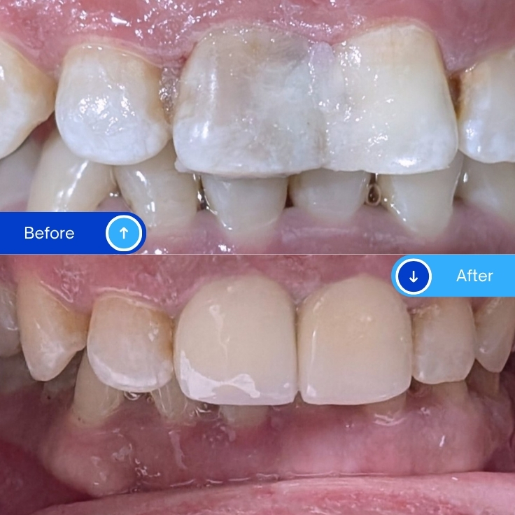 Zirconia Crowns (3)