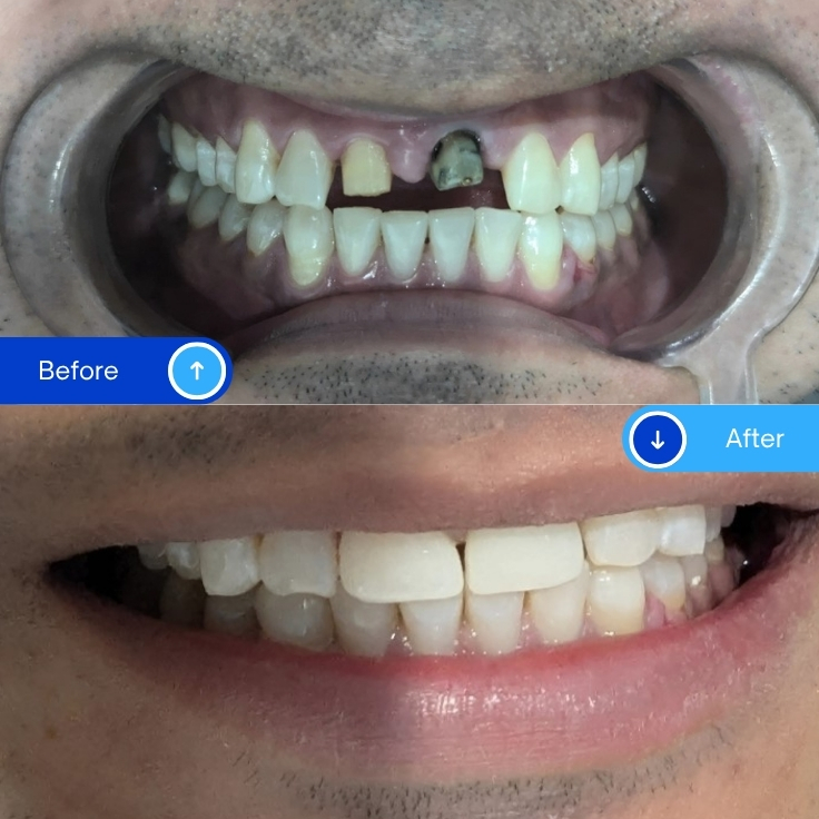Zirconia Crowns (4)