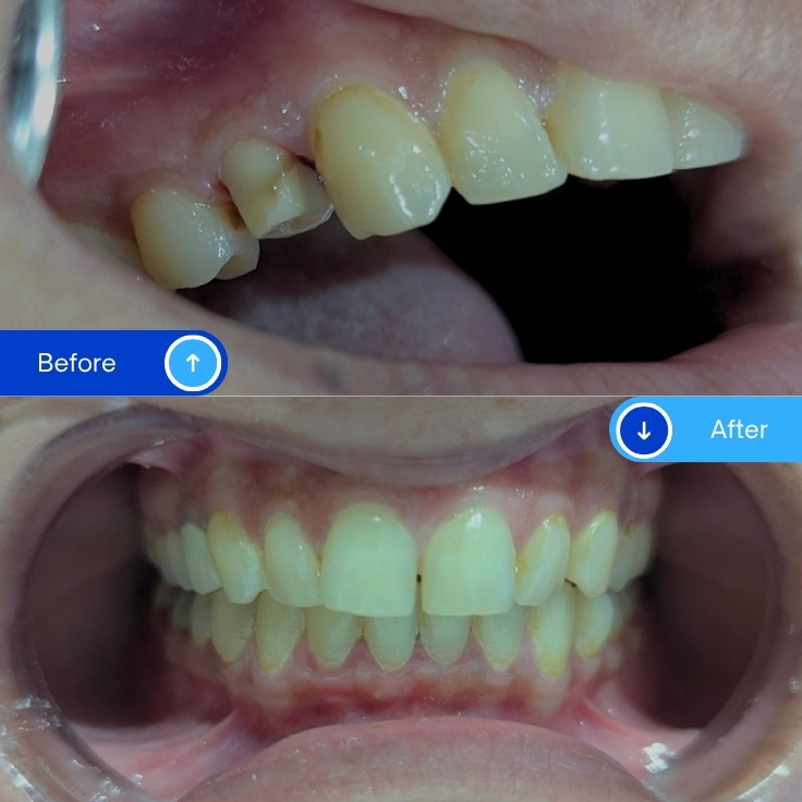 Zirconia Crowns (5)