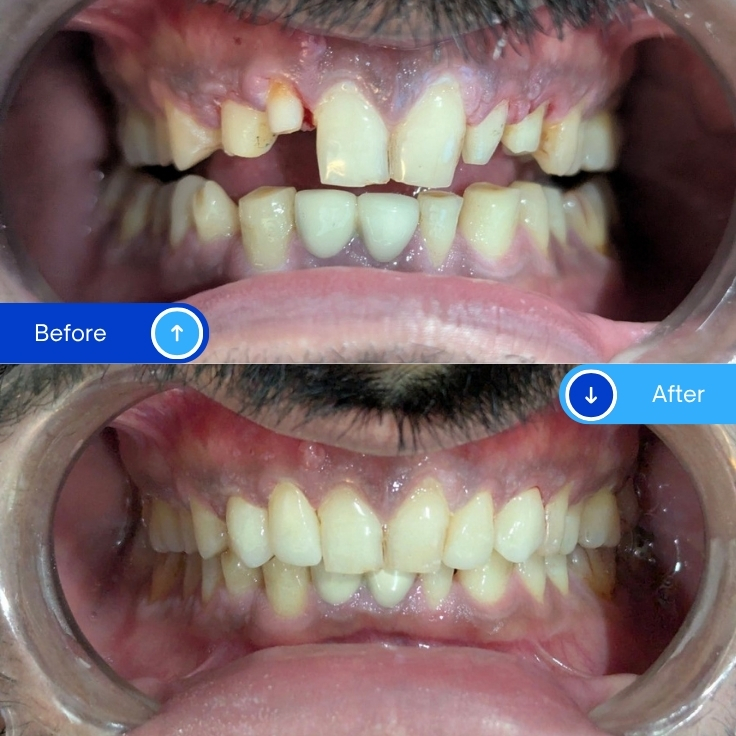 Zirconia Crowns