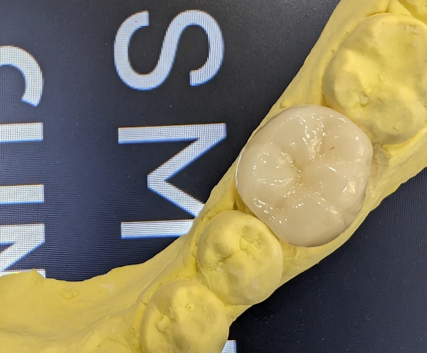zirconia corwn 1