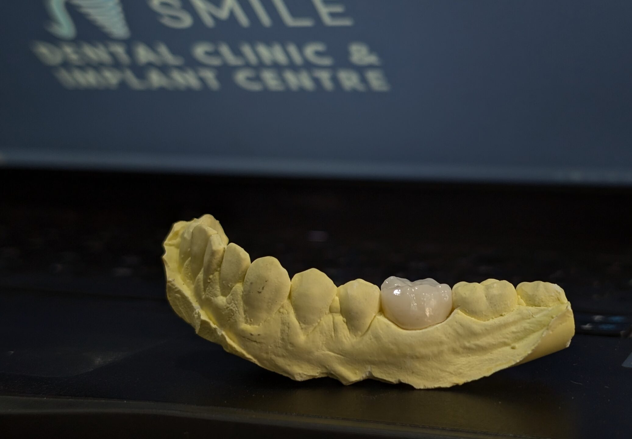 zirconia crown