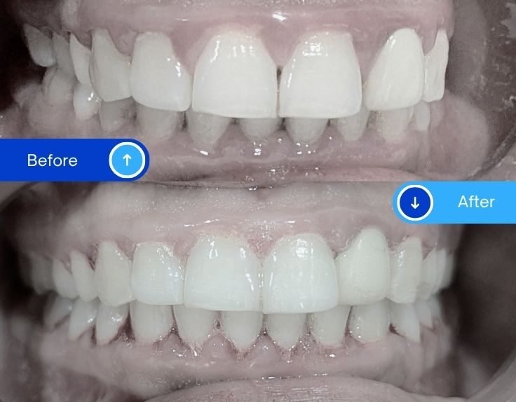 Braces (1)