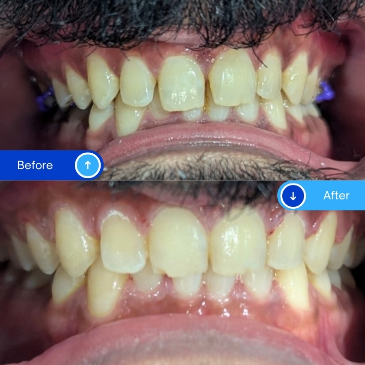 Braces (1)