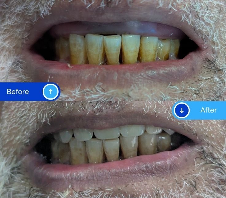 Braces (2)