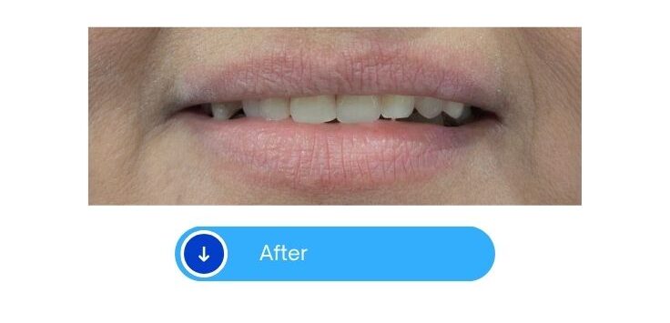Braces
