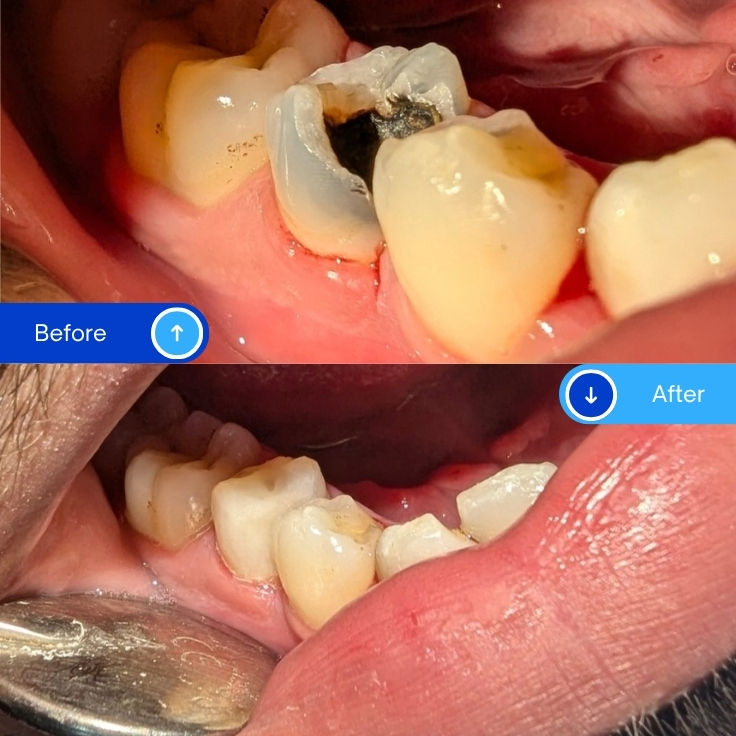 Composite Filling (10)