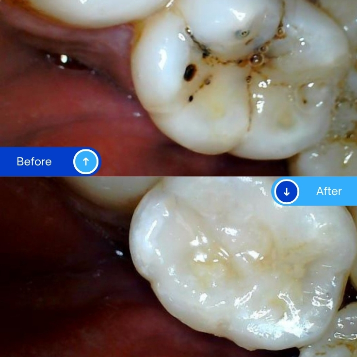 Composite Filling (13)