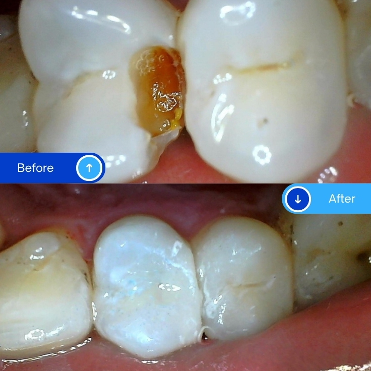 Composite Filling (14)