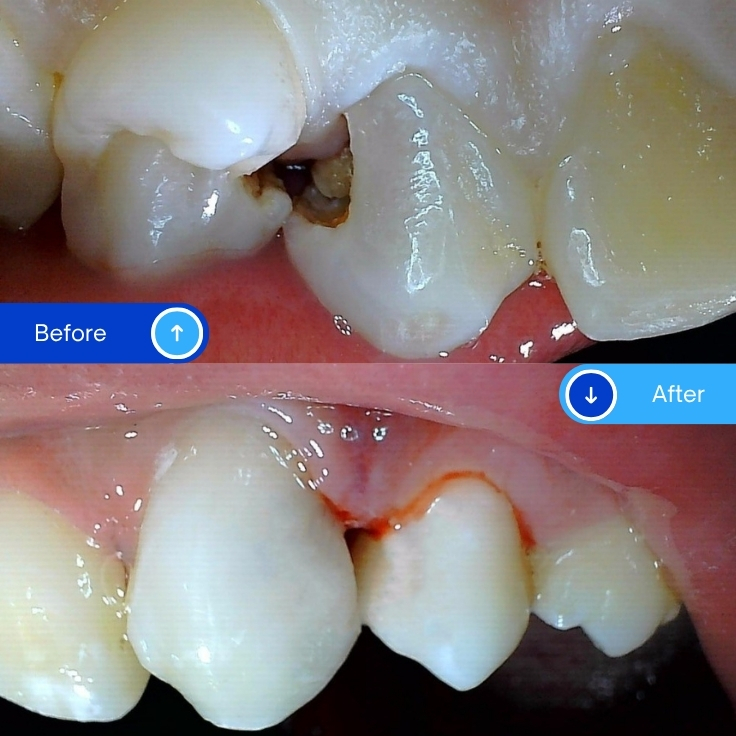Composite Filling (15)