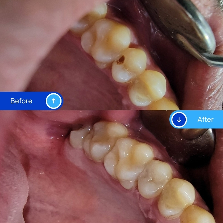 Composite Filling (17)