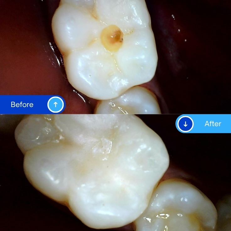 Composite Filling (2)