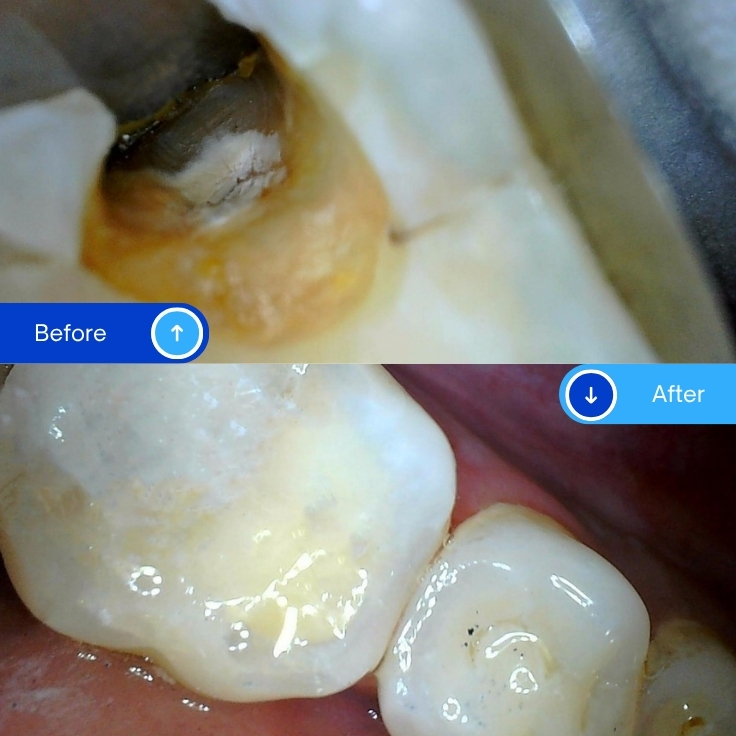 Composite Filling (4)