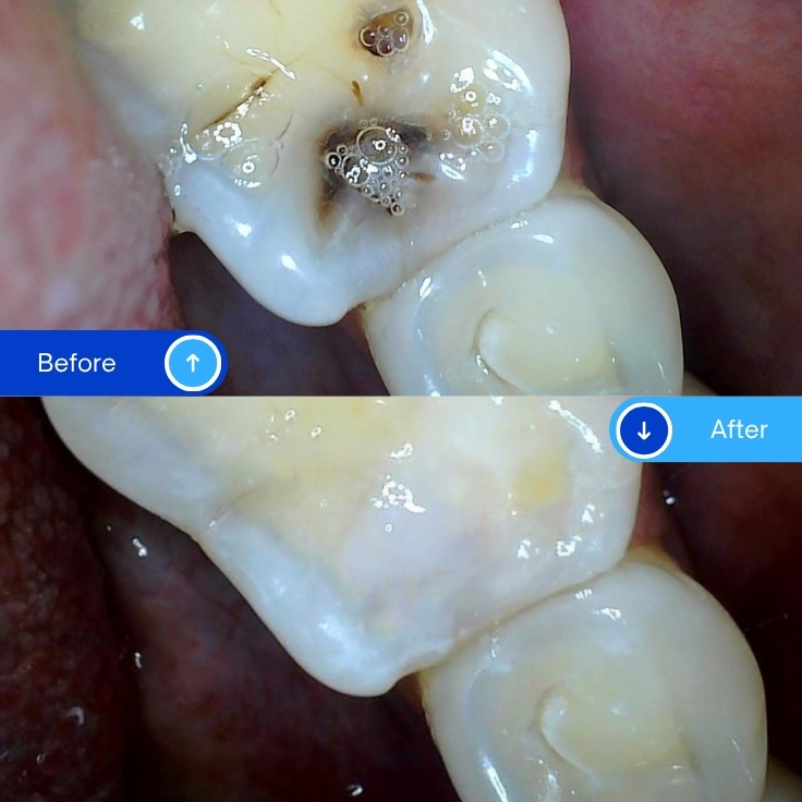 Composite Filling (5)