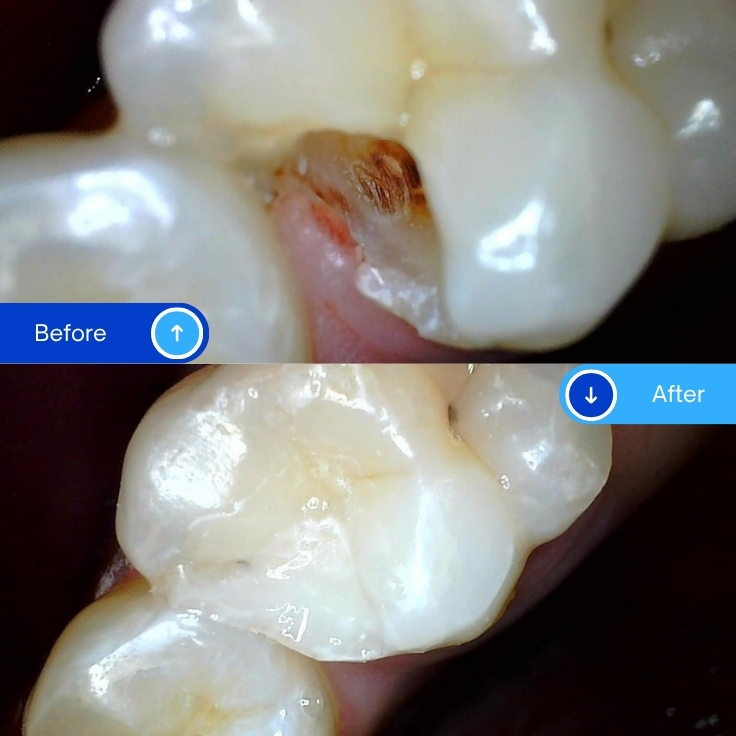 Composite Filling (8)