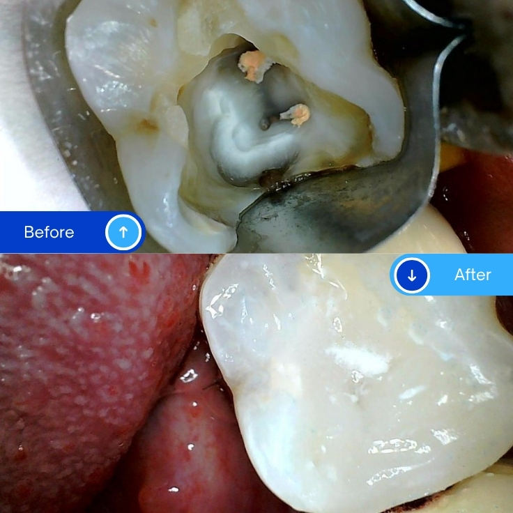 Composite Filling (9)