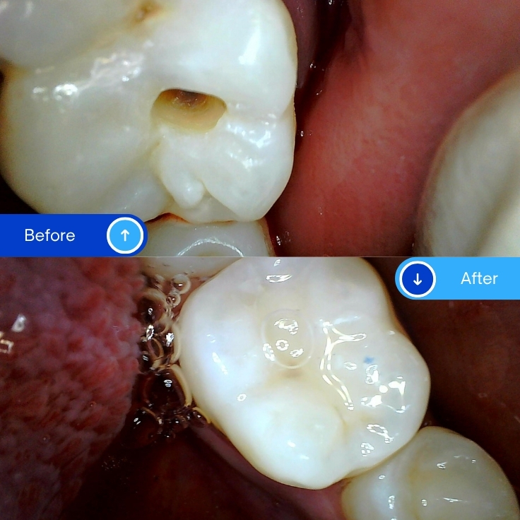 Composite Filling