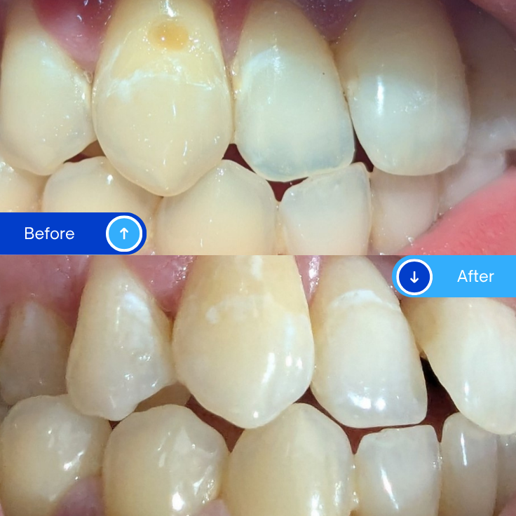 Composite Filling