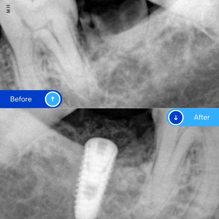 Implant (1)