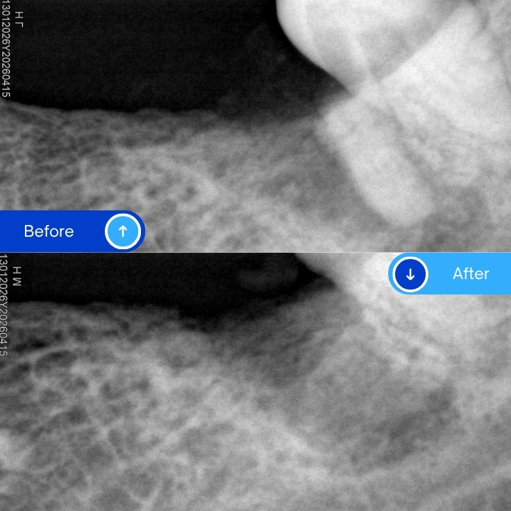 Surgical Extraction
