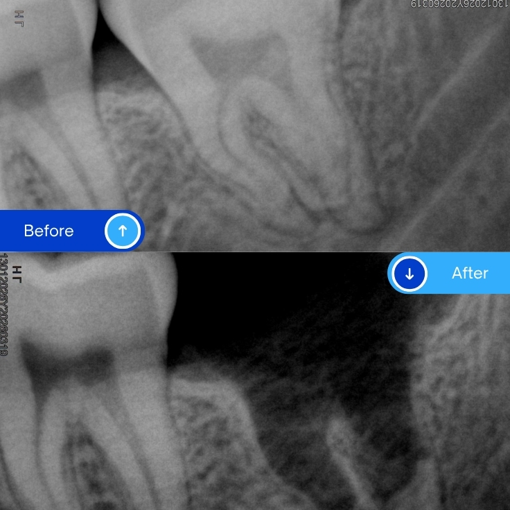Wisdom tooth extraction