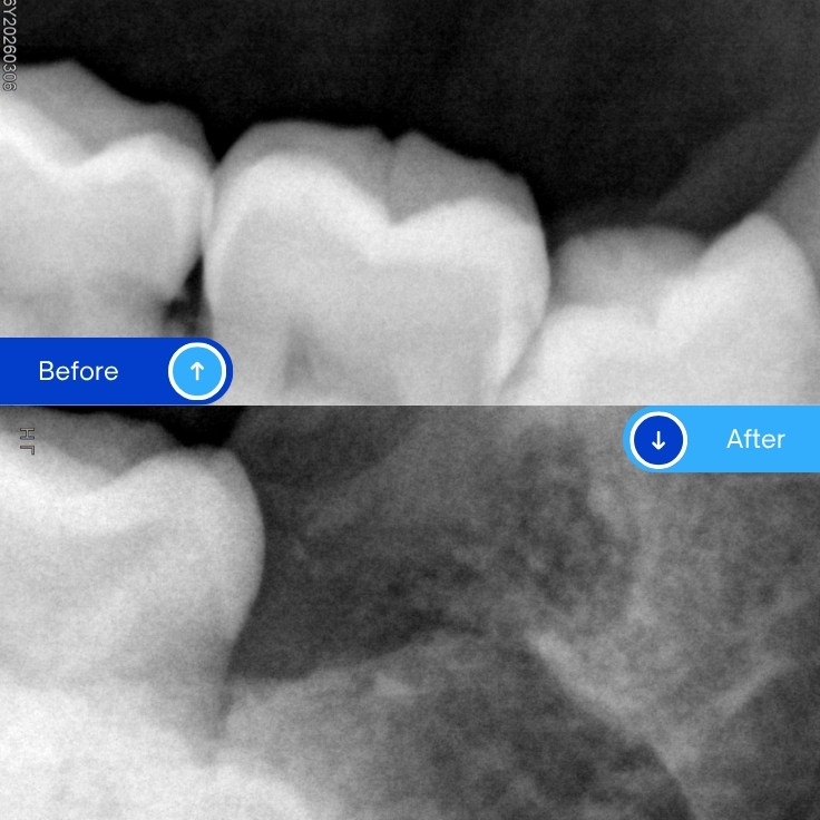 Wisdom tooth extraction (2)