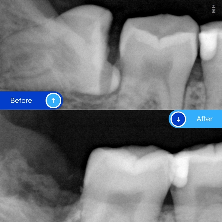 Wisdom tooth extraction (3)