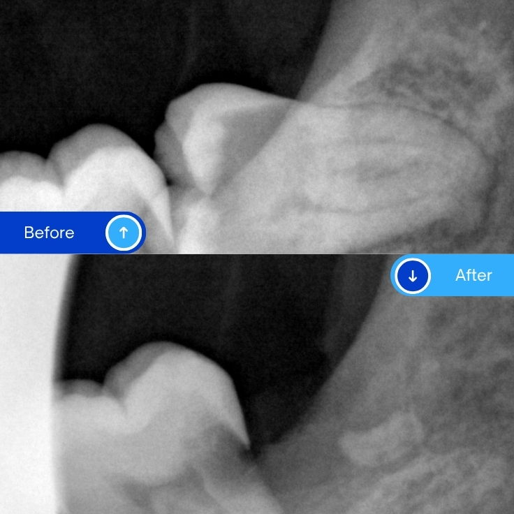 Wisdom tooth extraction (4)