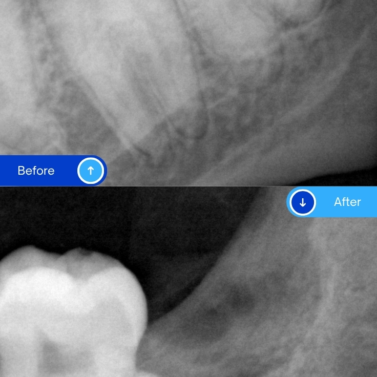 Wisdom tooth extraction (5)
